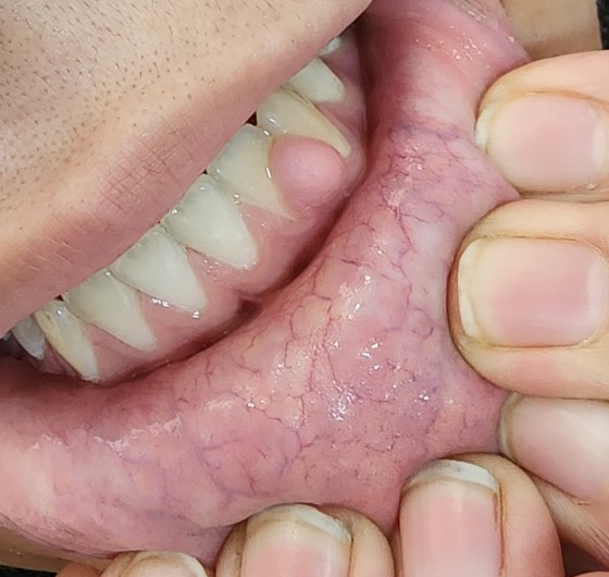 ضایعهٔ تحریکی پیش از برداشت با لیزر